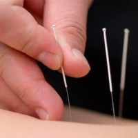 Sterile needles for acupuncture 0.30 x 50 (1000 pcs.), SAN-30-50-1000